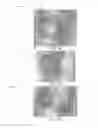 Fig. 07 - Catheter devices, systems and methods for injection of adhesive materials