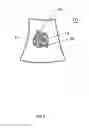 Fig. 03 - Three dimensional imaging ultrasound with microbubbles to enhance reflow in ST elevation myocardial infarction