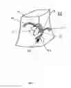Fig. 04 - Three dimensional imaging ultrasound with microbubbles to enhance reflow in ST elevation myocardial infarction