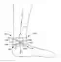 Fig. 01 - Tibial nerve stimulation device