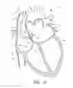 Fig. 11 - METHOD FOR DETECTING, DIAGNOSING, AND TREATING CARDIOVASCULAR DISEASE