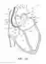 Fig. 13 - METHOD FOR DETECTING, DIAGNOSING, AND TREATING CARDIOVASCULAR DISEASE