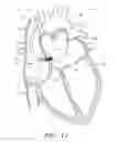 Fig. 14 - METHOD FOR DETECTING, DIAGNOSING, AND TREATING CARDIOVASCULAR DISEASE