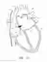 Fig. 15 - METHOD FOR DETECTING, DIAGNOSING, AND TREATING CARDIOVASCULAR DISEASE