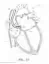 Fig. 16 - METHOD FOR DETECTING, DIAGNOSING, AND TREATING CARDIOVASCULAR DISEASE