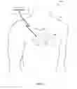 Fig. 03 - Ventricular leadless pacing device mode switching