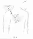 Fig. 04 - Ventricular leadless pacing device mode switching