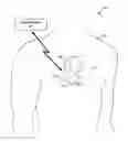 Fig. 01 - Mode switching by a ventricular leadless pacing device