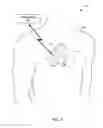 Fig. 03 - Mode switching by a ventricular leadless pacing device
