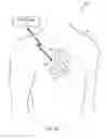 Fig. 04 - Mode switching by a ventricular leadless pacing device
