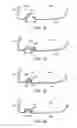 Fig. 17 - Golf club head with flexure