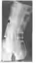 Fig. 05 - Mold for forming a joint spacer device or a part thereof