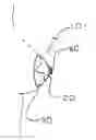 Fig. 01 - ILLUMINATED NIPPLE COVER