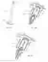 Fig. 22 - Long lifetime cold cathode ionization vacuum gauge design