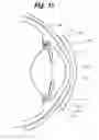 Fig. 08 - Partial corneal conjunctival contact lens