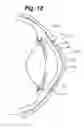 Fig. 09 - Partial corneal conjunctival contact lens