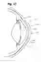 Fig. 10 - Partial corneal conjunctival contact lens