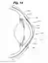 Fig. 11 - Partial corneal conjunctival contact lens