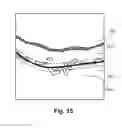 Fig. 16 - Robust segmentation of retinal pigment epithelium layer