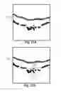 Fig. 24 - Robust segmentation of retinal pigment epithelium layer