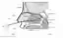 Fig. 01 - Method of performing a sphenopalatine ganglion block procedure