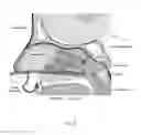 Fig. 12 - Method of performing a sphenopalatine ganglion block procedure
