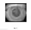 Fig. 07 - Methods for Objectively Determining the Visual Axis of the Eye and Measuring Its Refraction