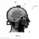 Fig. 17 - Integrated multimodal sensor device for intracranial neuromonitoring