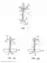 Fig. 02 - Medical device for wound closure and method of use