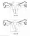 Fig. 02 - SURGICAL CAPTURE DEVICE AND METHODS OF USE