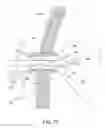 Fig. 14 - SURGICAL CAPTURE DEVICE AND METHODS OF USE
