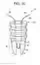 Fig. 03 - Suture anchor system with compressible distal tip