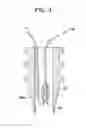 Fig. 05 - Suture anchor system with compressible distal tip