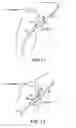 Fig. 08 - Device and method for suturing intracardiac defects