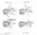 Fig. 17 - Methods for passing multiple sutures through tissue