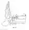 Fig. 18 - Surgical instrumentation and methods of use for implanting a prosthesis