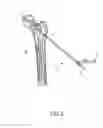 Fig. 03 - SYSTEM AND METHOD OF TREATMENT OF BONE LESIONS