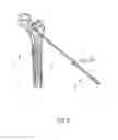 Fig. 07 - SYSTEM AND METHOD OF TREATMENT OF BONE LESIONS