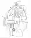 Fig. 01 - Gap referencing femoral sizer
