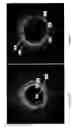 Fig. 05 - Identification of elastic lamina to guide interventional therapy