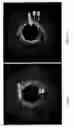 Fig. 06 - Identification of elastic lamina to guide interventional therapy