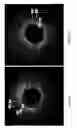 Fig. 07 - Identification of elastic lamina to guide interventional therapy