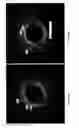 Fig. 09 - Identification of elastic lamina to guide interventional therapy