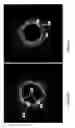 Fig. 11 - Identification of elastic lamina to guide interventional therapy