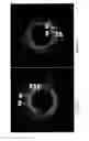 Fig. 14 - Identification of elastic lamina to guide interventional therapy