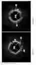 Fig. 16 - Identification of elastic lamina to guide interventional therapy