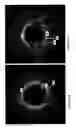 Fig. 18 - Identification of elastic lamina to guide interventional therapy