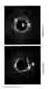 Fig. 21 - Identification of elastic lamina to guide interventional therapy