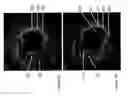 Fig. 22 - Identification of elastic lamina to guide interventional therapy