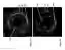Fig. 23 - Identification of elastic lamina to guide interventional therapy